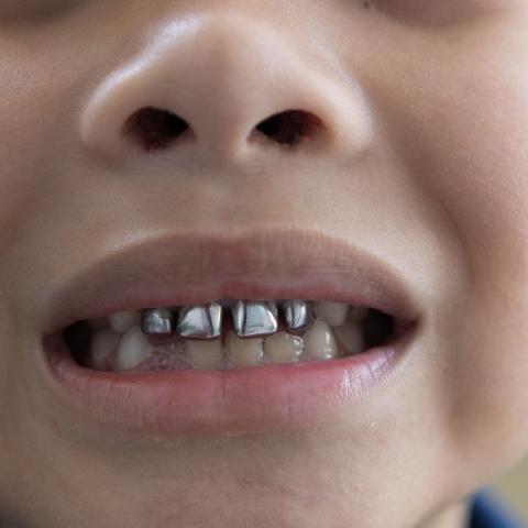STAINLESS STEEL CROWNS IN PEDIATRIC DENTISTRY